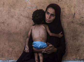 A woman holds a severely malnourished child in Gaza.